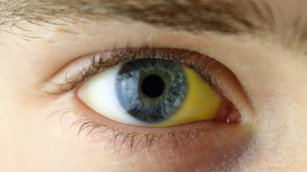 Lebertest - gelbe Augen